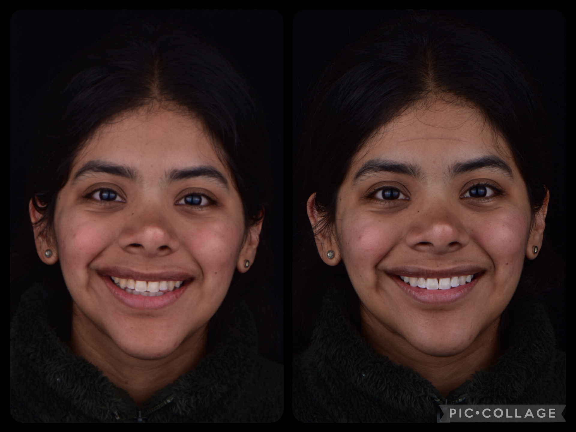blanqueamiento-dental-01