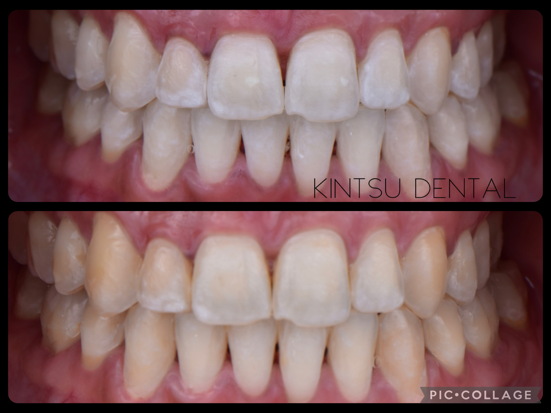 blanqueamiento-dental-02