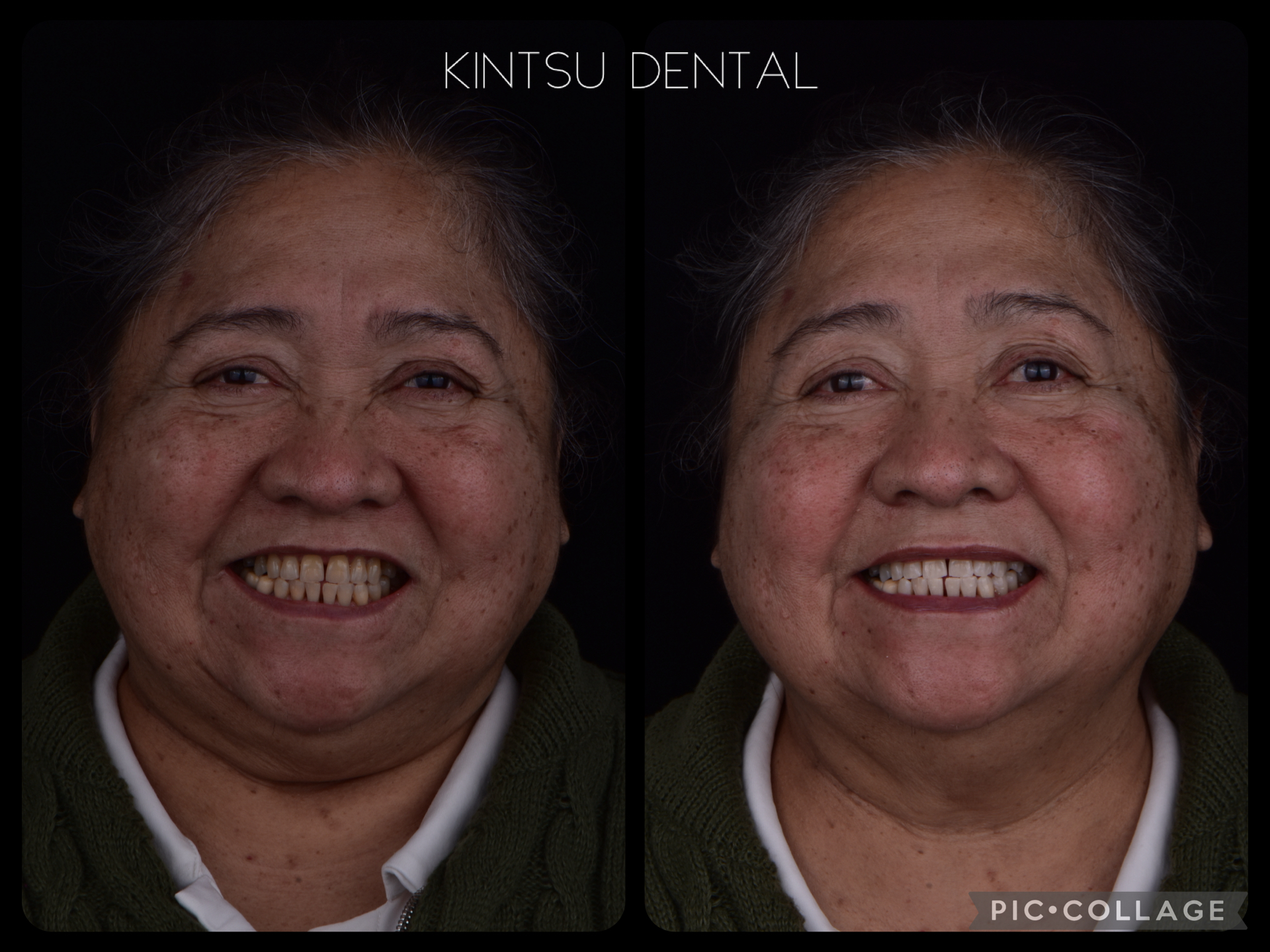 blanqueamiento-dental-03