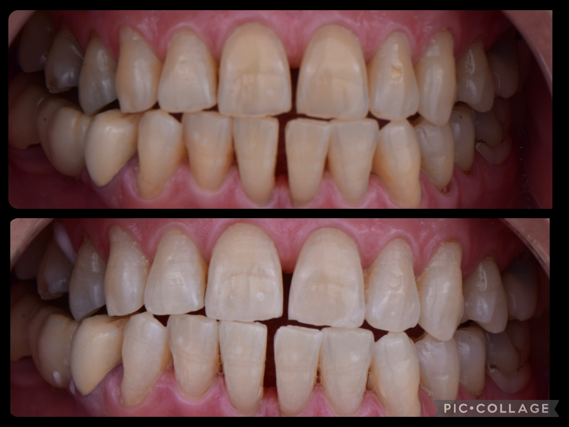 blanqueamiento-dental-04