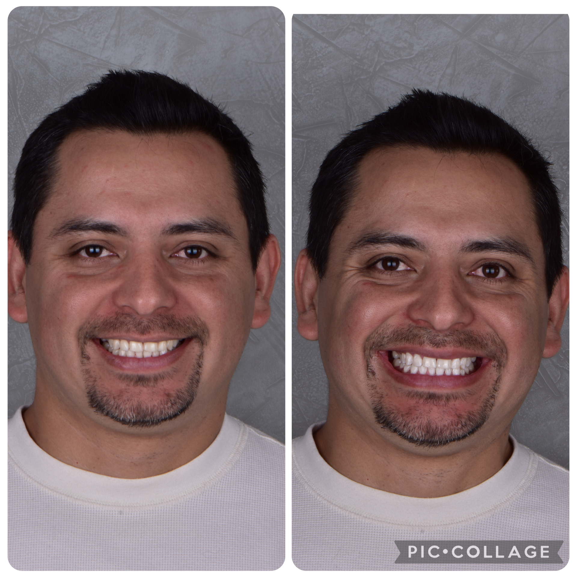blanqueamiento-dental-05
