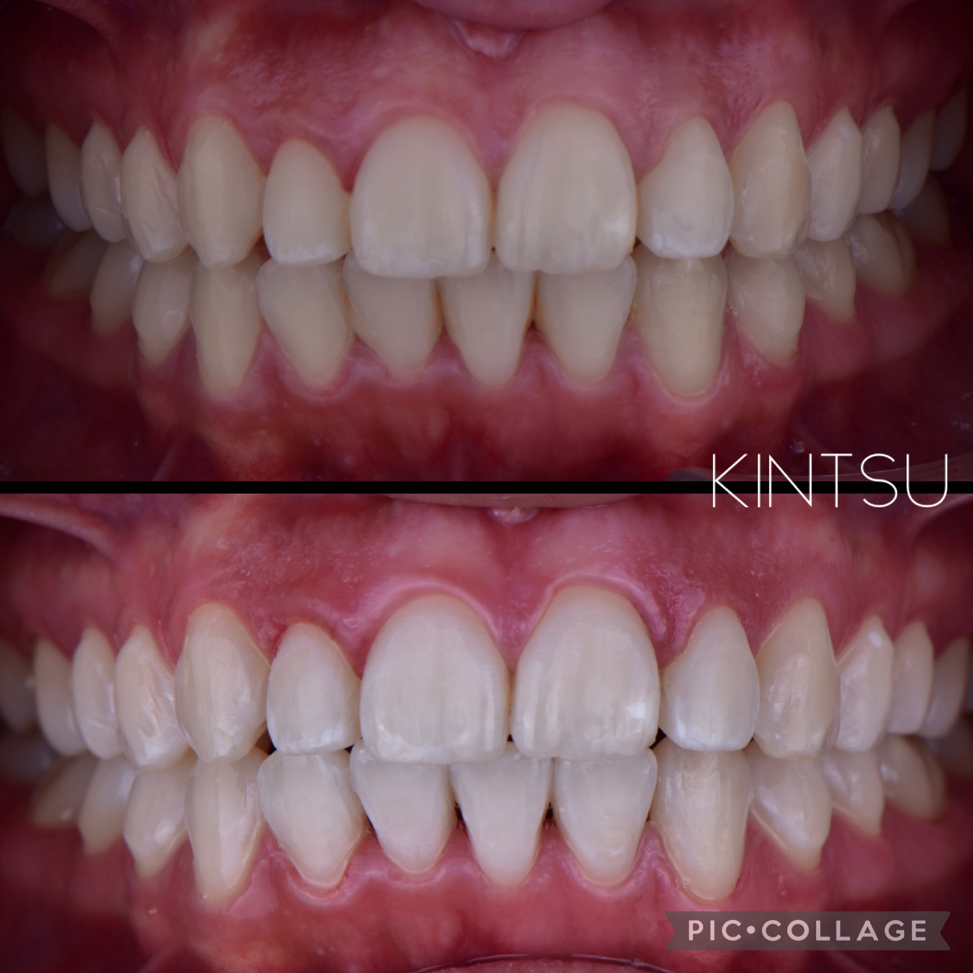 blanqueamiento-dental-06