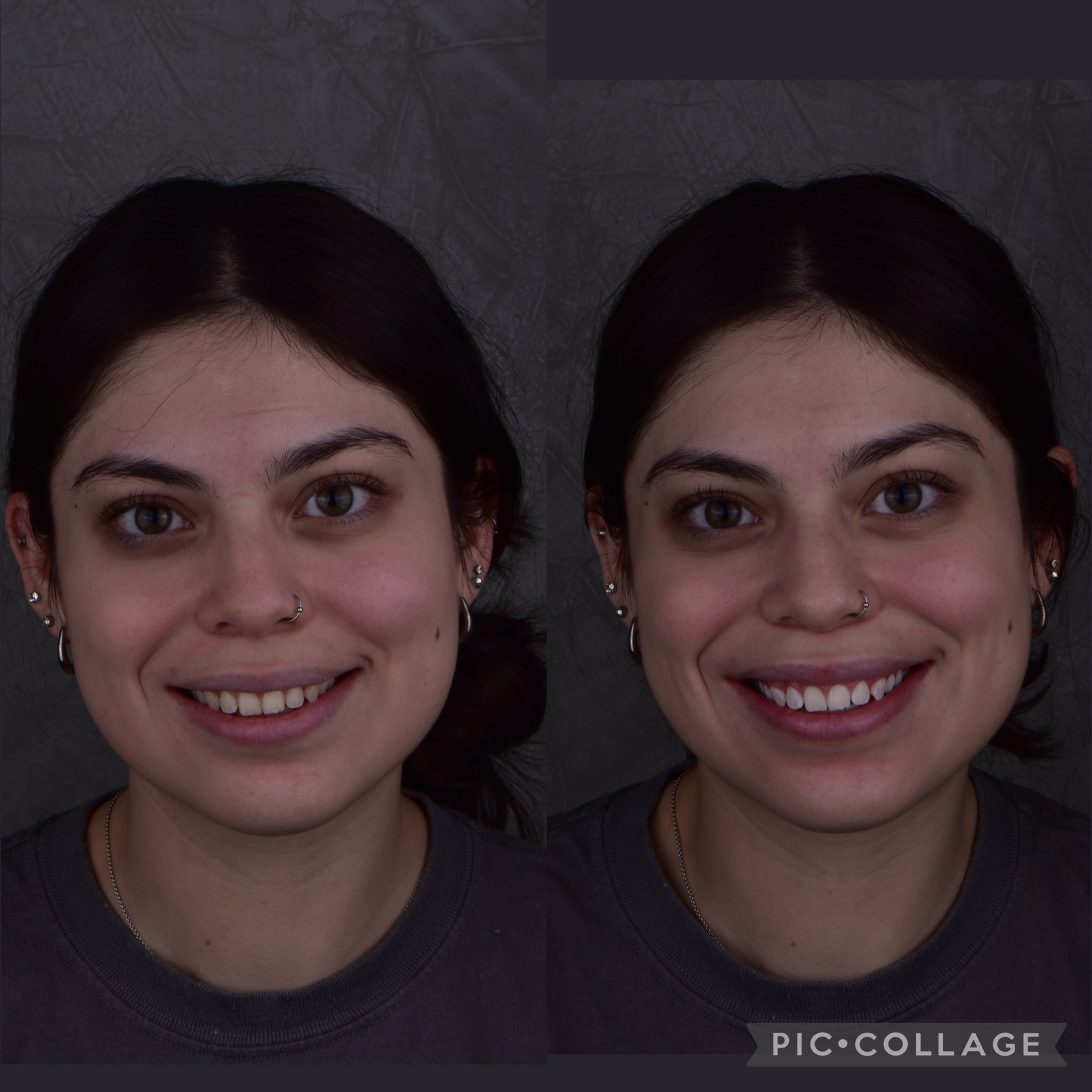 blanqueamiento-dental-07