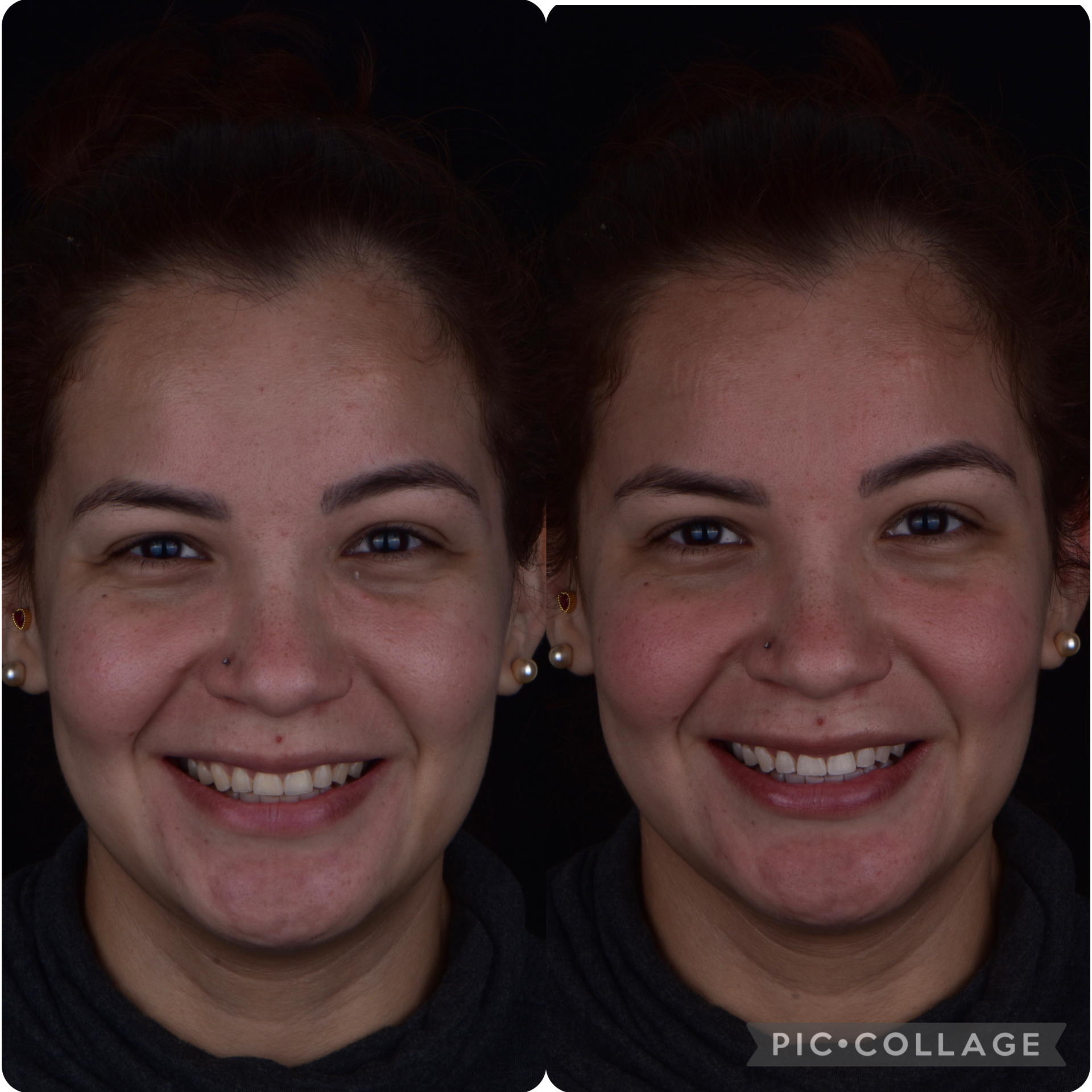 blanqueamiento-dental-08